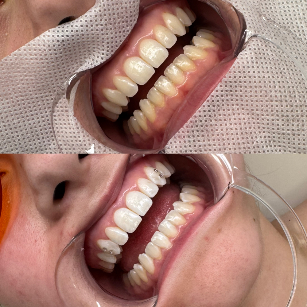 Teeth Whitening 60 Min Session at Jojobeautyyco in Chandler, AZ