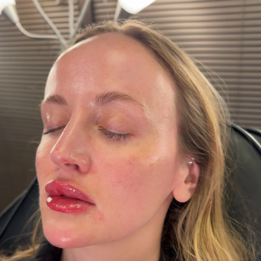 Botox at Enhance Aesthetics Medspa in Arlington, TX