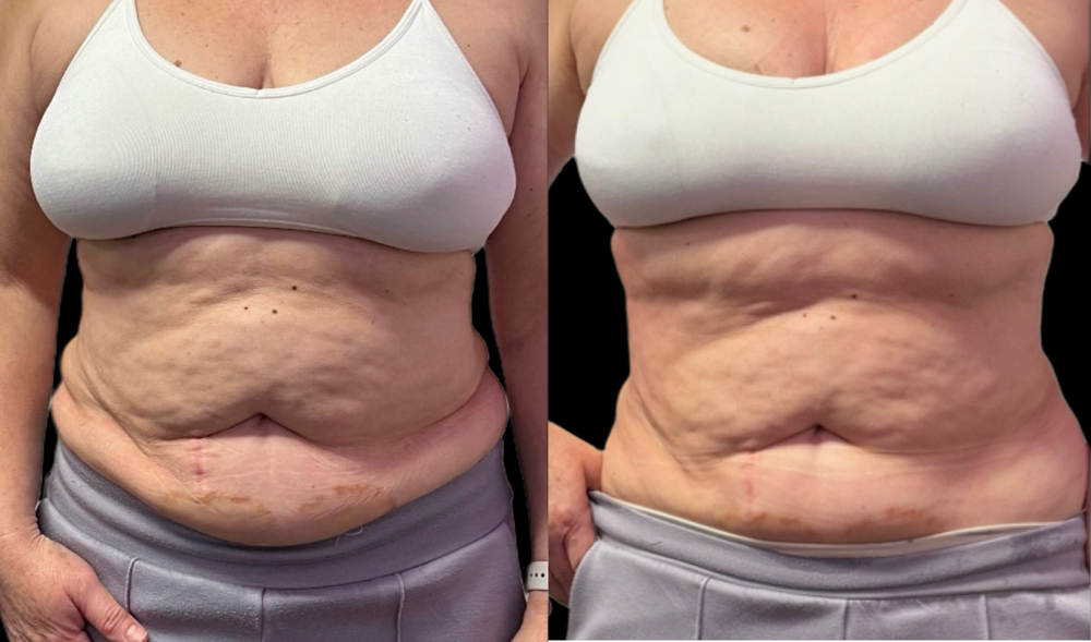 Fat Cavitation + RF (1 Area)