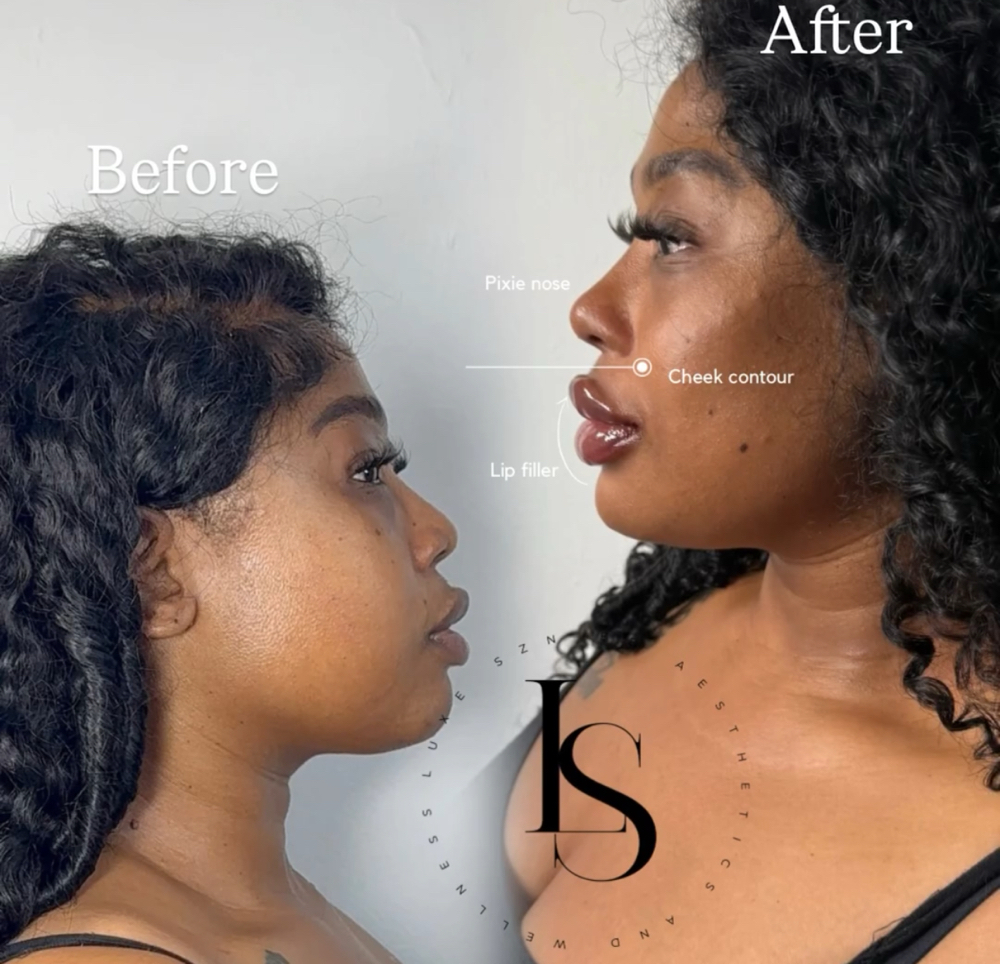 Lyft & Sculpt (Cheeks & Chin)
