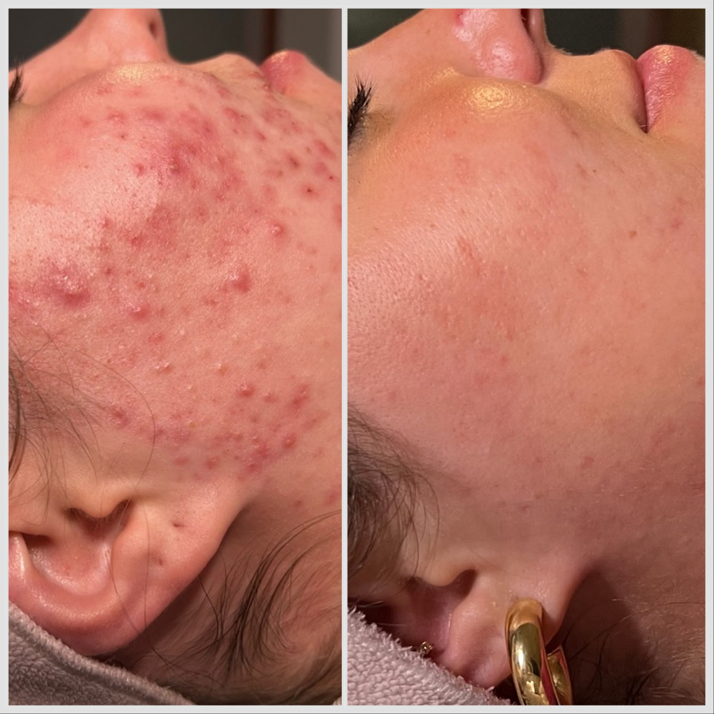 CLEAR SKIN CONSULT + FACIAL at Bliss Skin by Sam LLC in Lafayette, IN