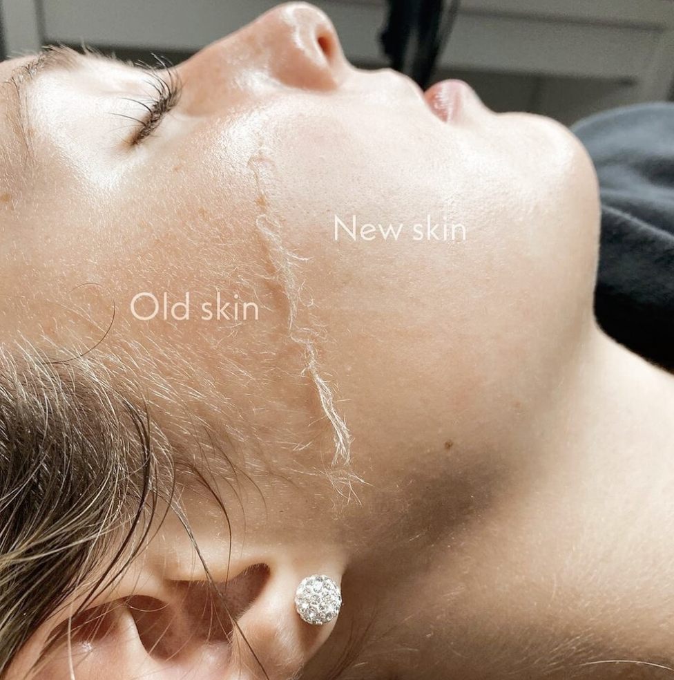 Dermaplane Add On