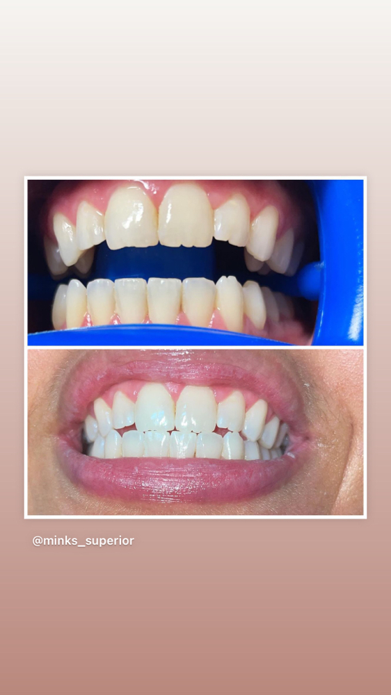 Children Cosmetic Teeth Whitening