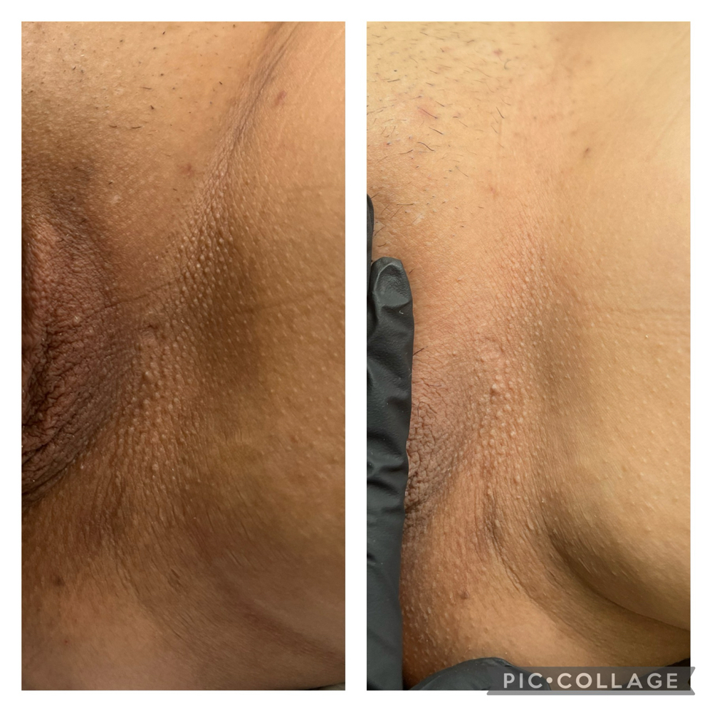 Brazilian Lightening Treatment