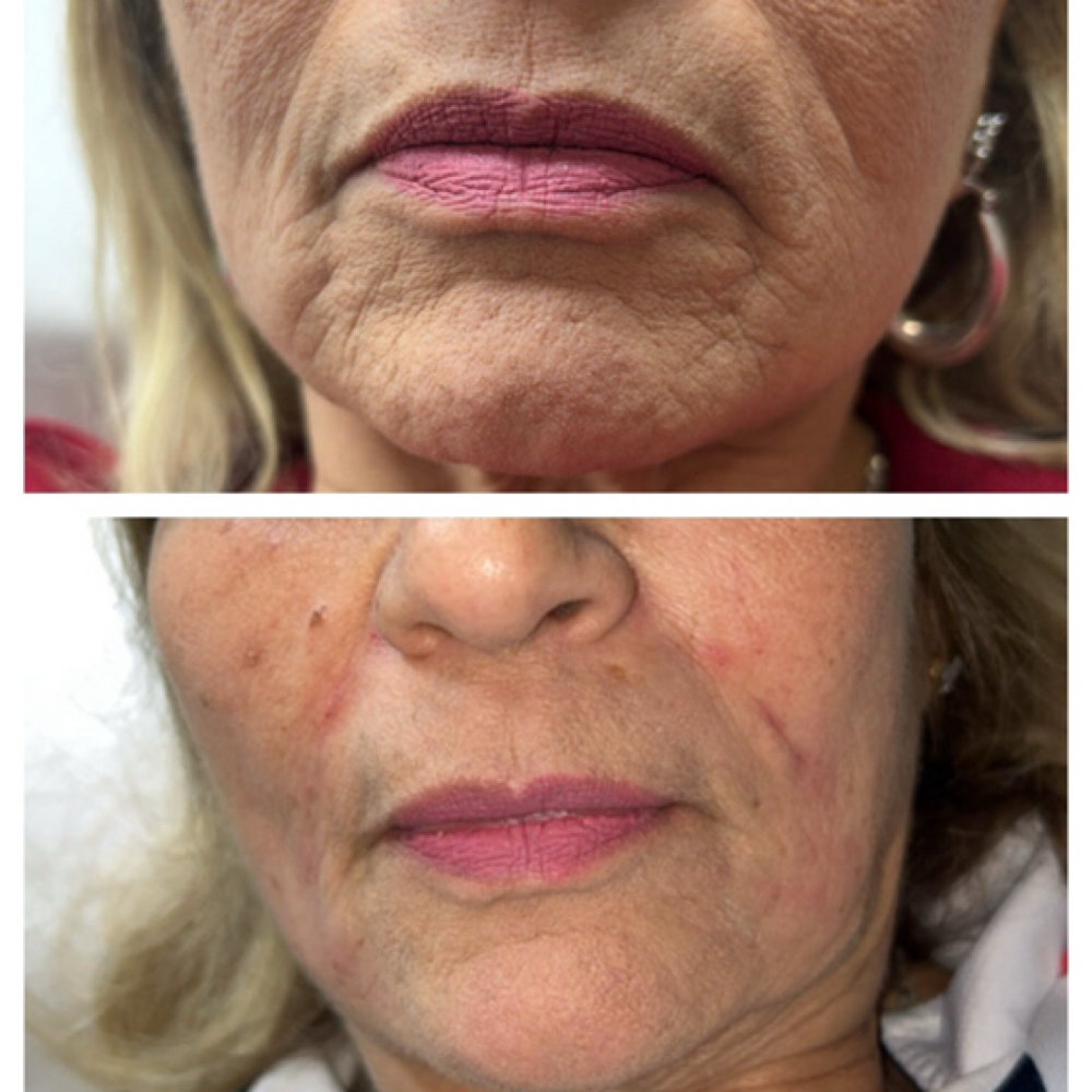 Marionette Lines Filler Correction at Kat Marie Aesthetics in Humble, TX