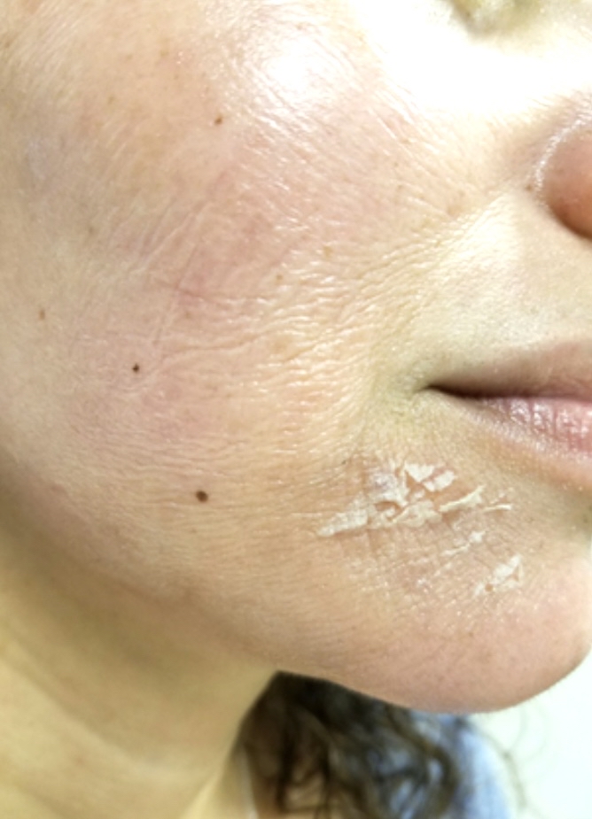 Advanced Chemical Peel