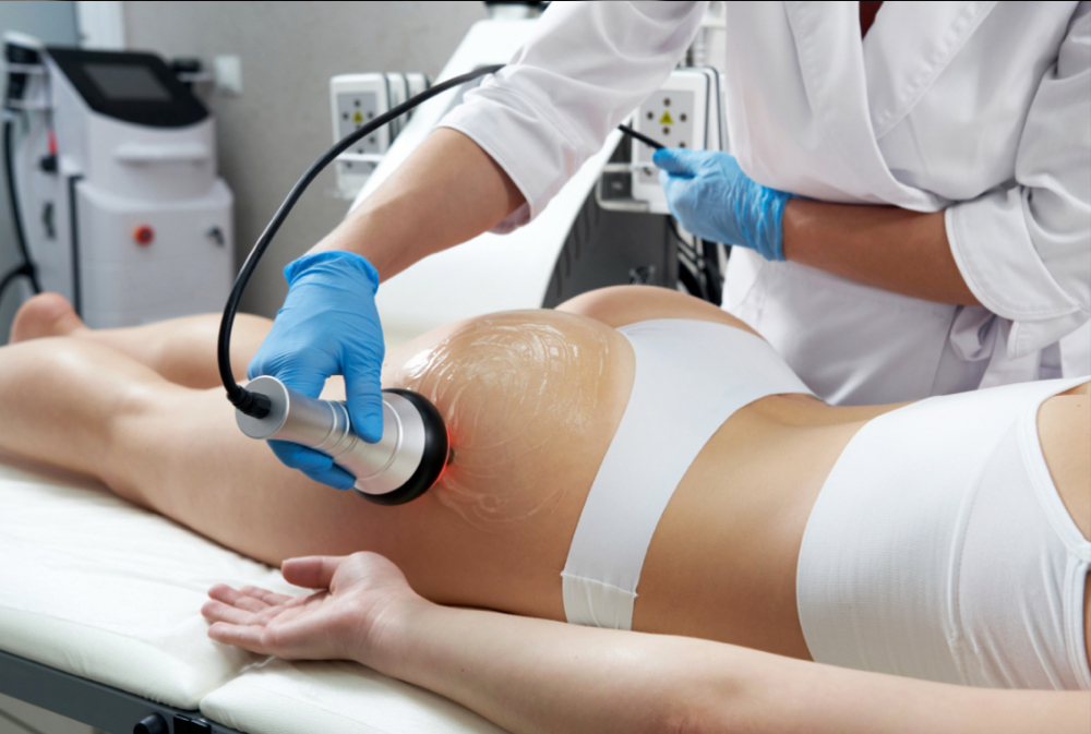 Trusculpt Body Contouring