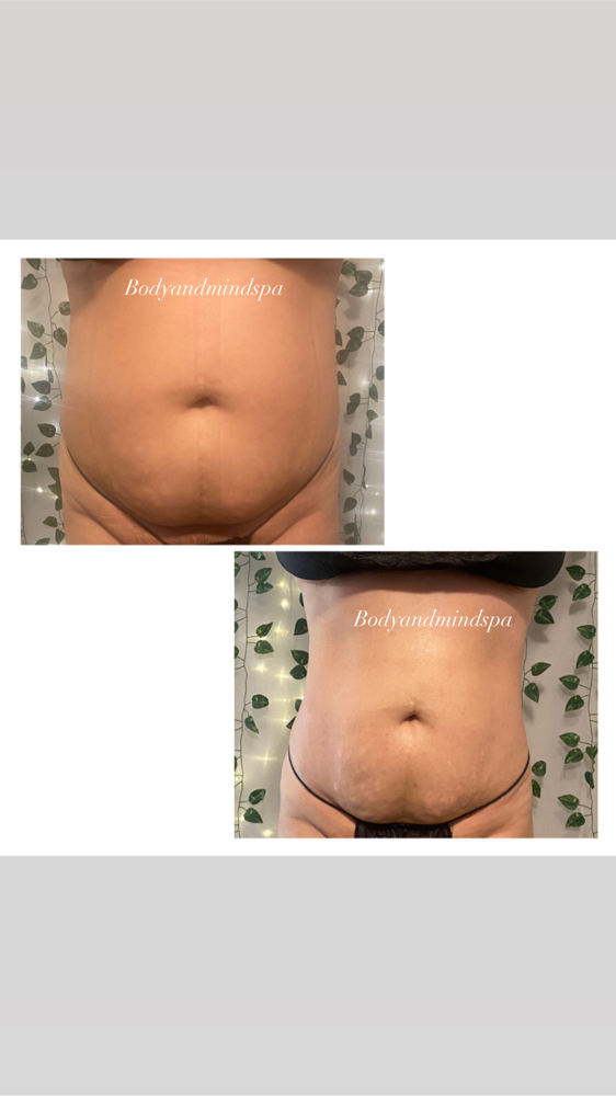 Tummy Combo With Fat Dissolvers