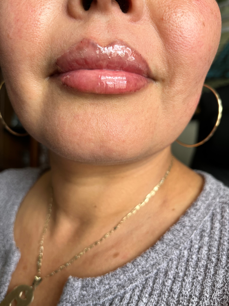 Lip Fillers Full Syringe