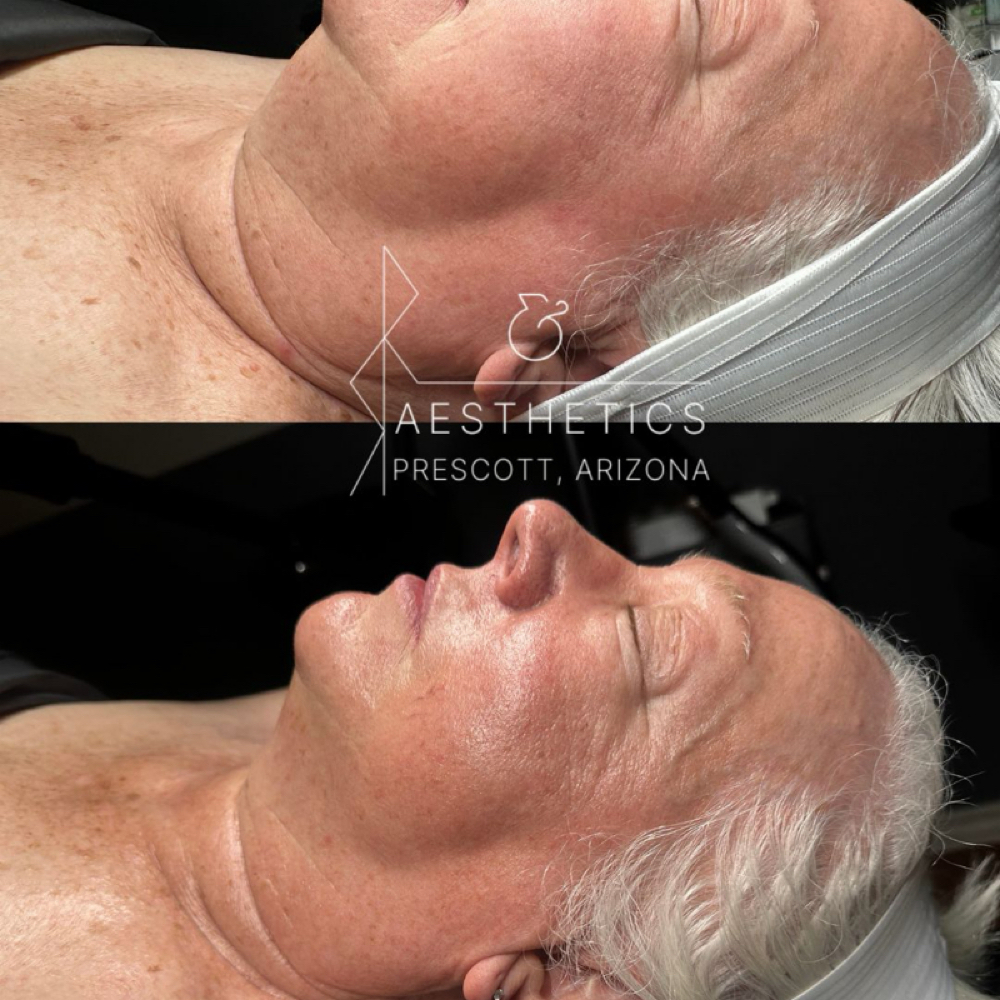 Silver Anti Aging (Tier 2) at R&R Aesthetics - Prescott, Arizona in Prescott, AZ