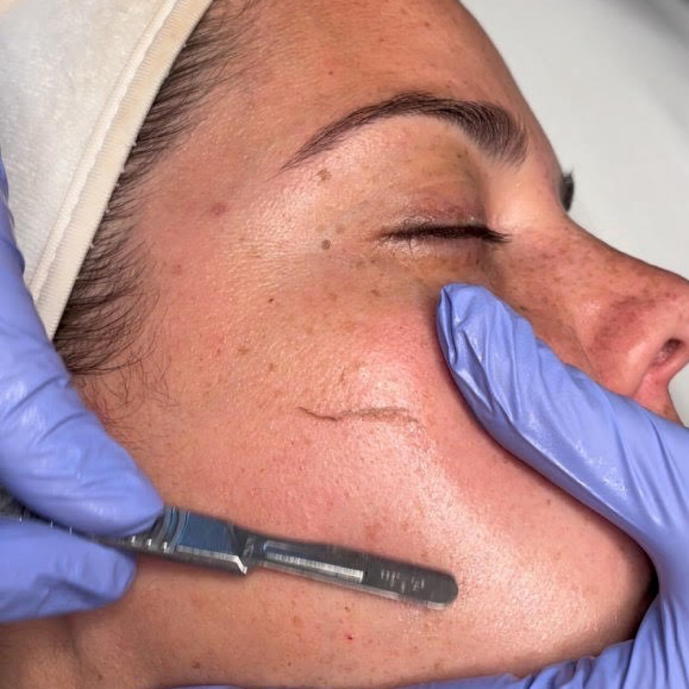 Dermaplane Mini at Pretty Billy Beauty in Lafayette, NJ