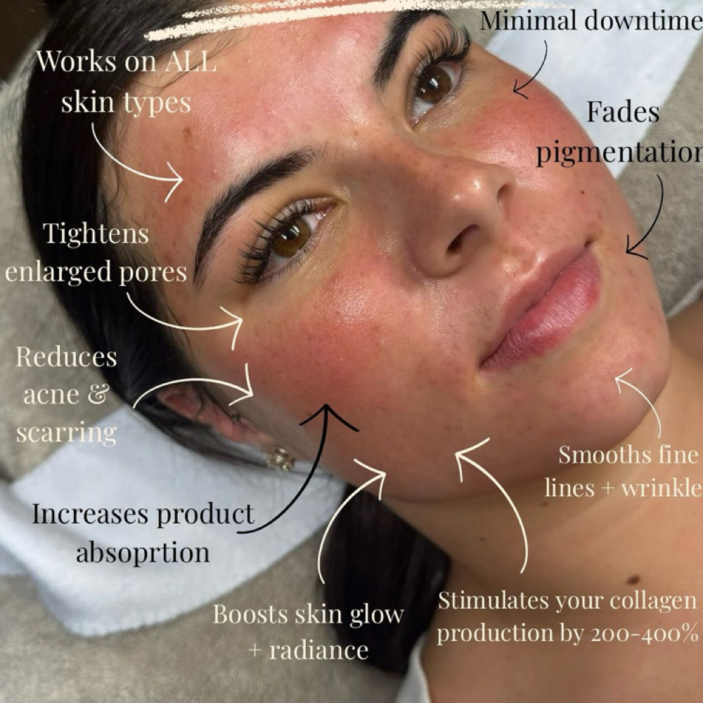 Rejuvenation Microneedling Facial