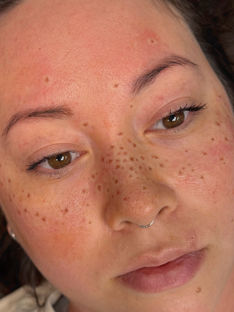 Permanent Freckles — Heavy Coverage