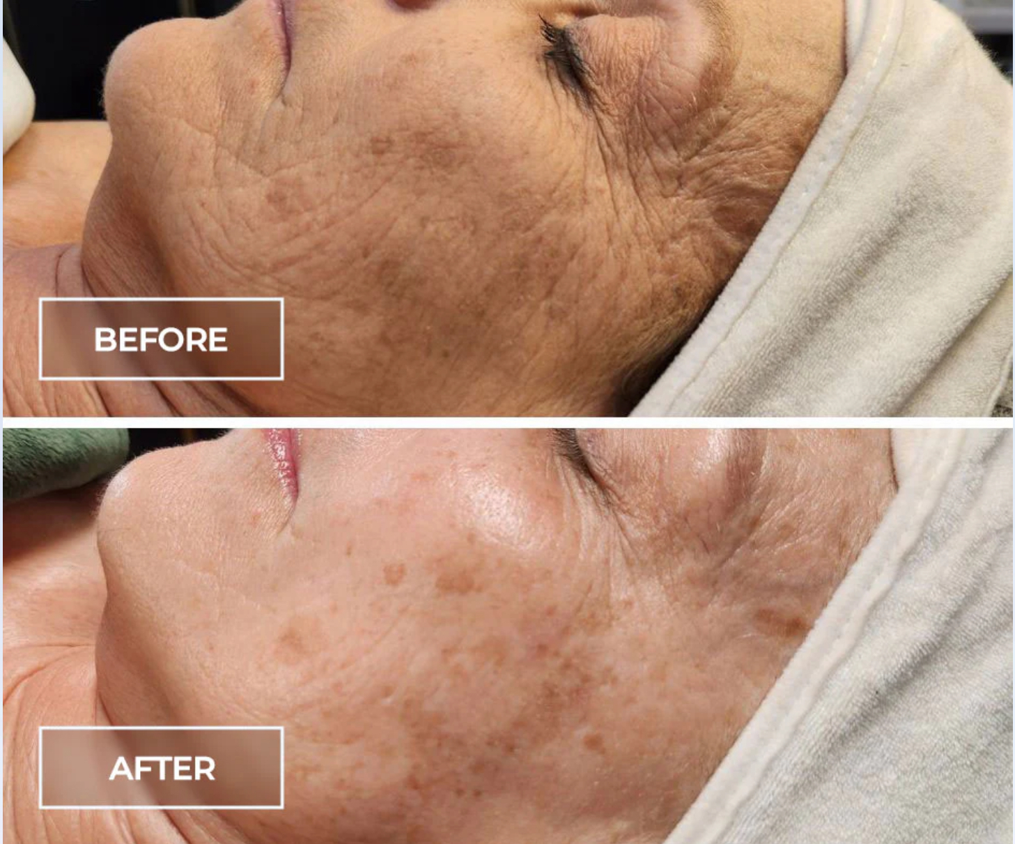 The Age Reversal at Elevé Aesthetics in Columbus, OH