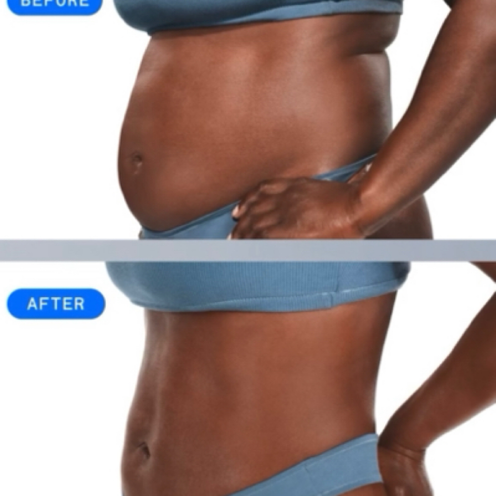 Coolsculpting Contsultation at Advanced Aesthetics & Lash Studio in Salem, OR