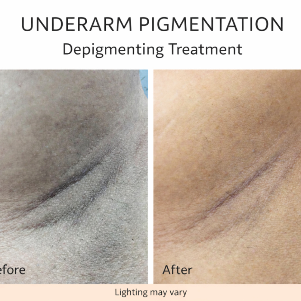 Underarm Brightening & Renewal at HOPE_SKINCARESTUDIO in Sacramento, CA