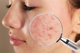 Clear Radiance Therapy at Anointed Aesthetics in Pasadena, TX