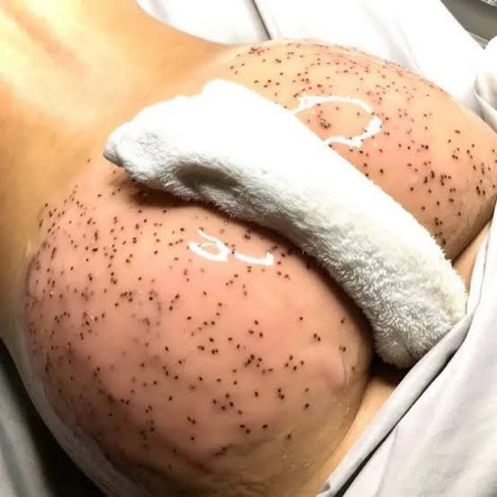 Glute Rejuvenation Facial at WaxLand & BodySculpting in Los Angeles, CA