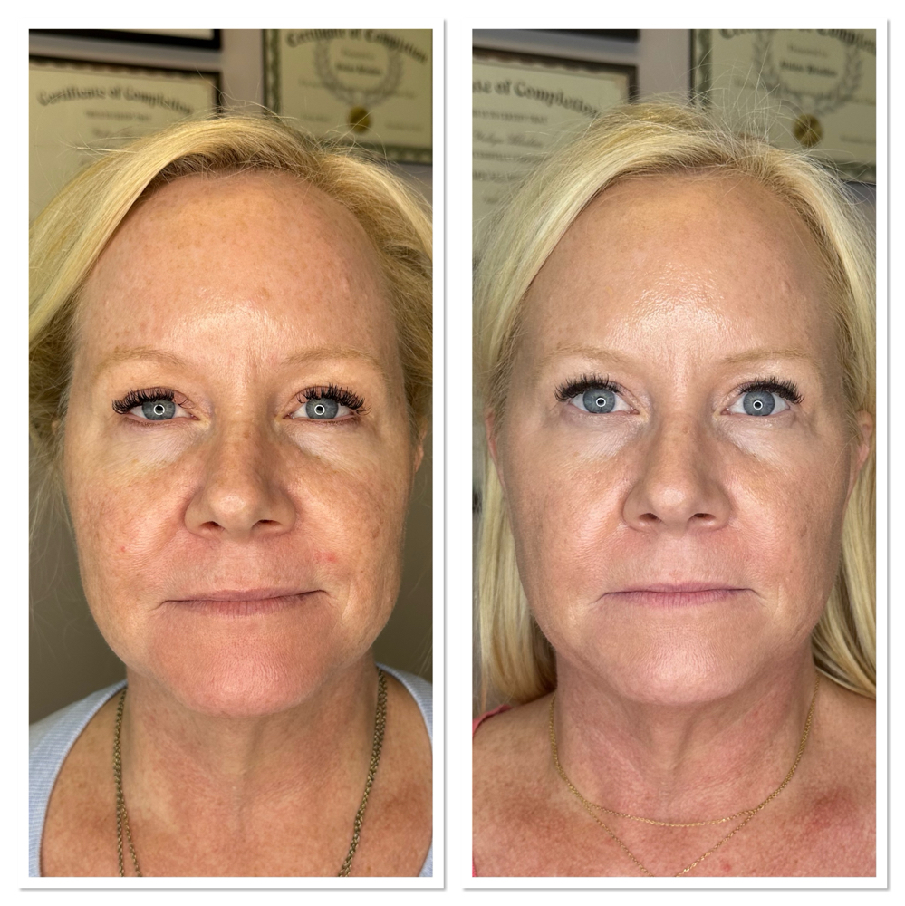 Erbium Resurfacing Face & Neck