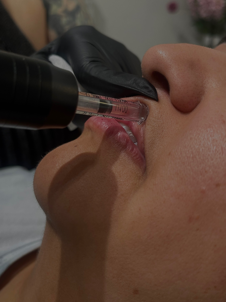 Hyaluron Pen Needlefree Injections at Mayumi Aesthetics in Covina, CA