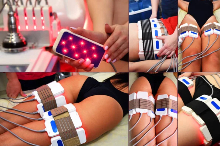 Laser Lipo