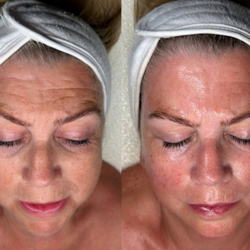 Instant Lift Facial at Glam Muse Aesthetics in Garden City, NY