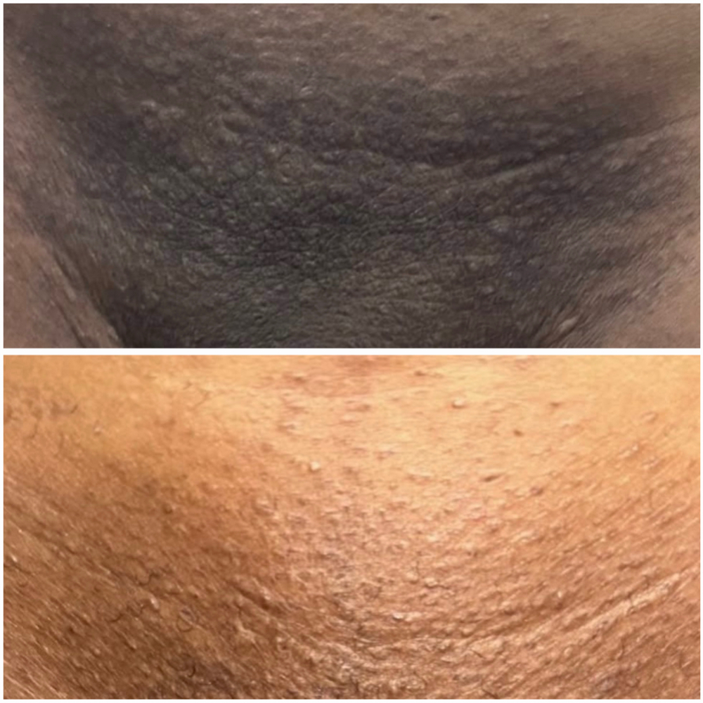 Deluxe Brightening Vajacial at YourTru Beauty in Altamonte Springs, FL