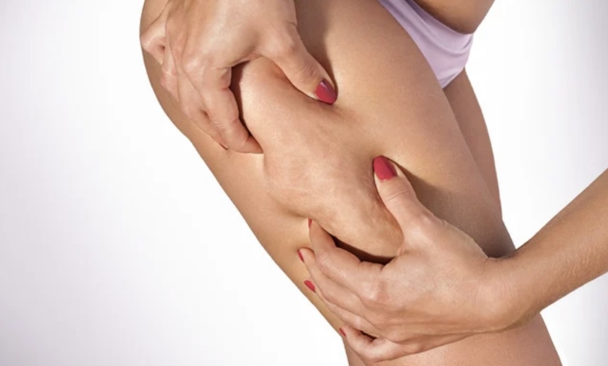 Thigh Fat Reduction Treatment at Body By The Beach LLC in Panama City Beach, FL
