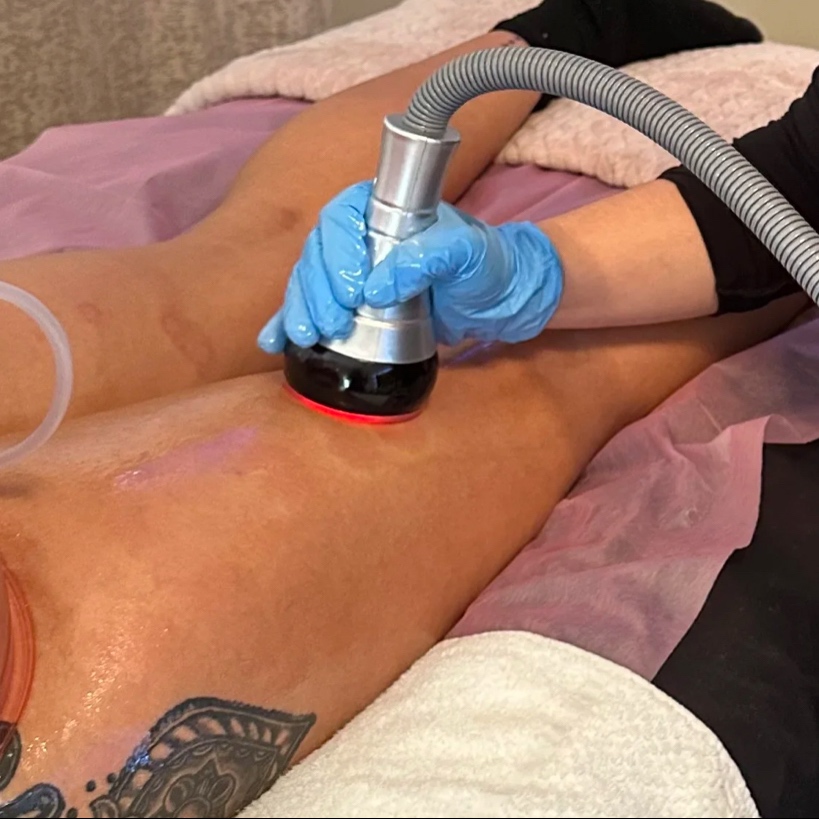 Vacuum Cellulite Therapy