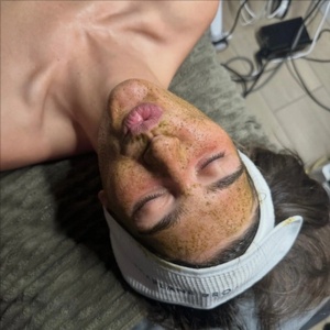 "Age Rewind" Spicule Peel at Marco Island Aesthetics