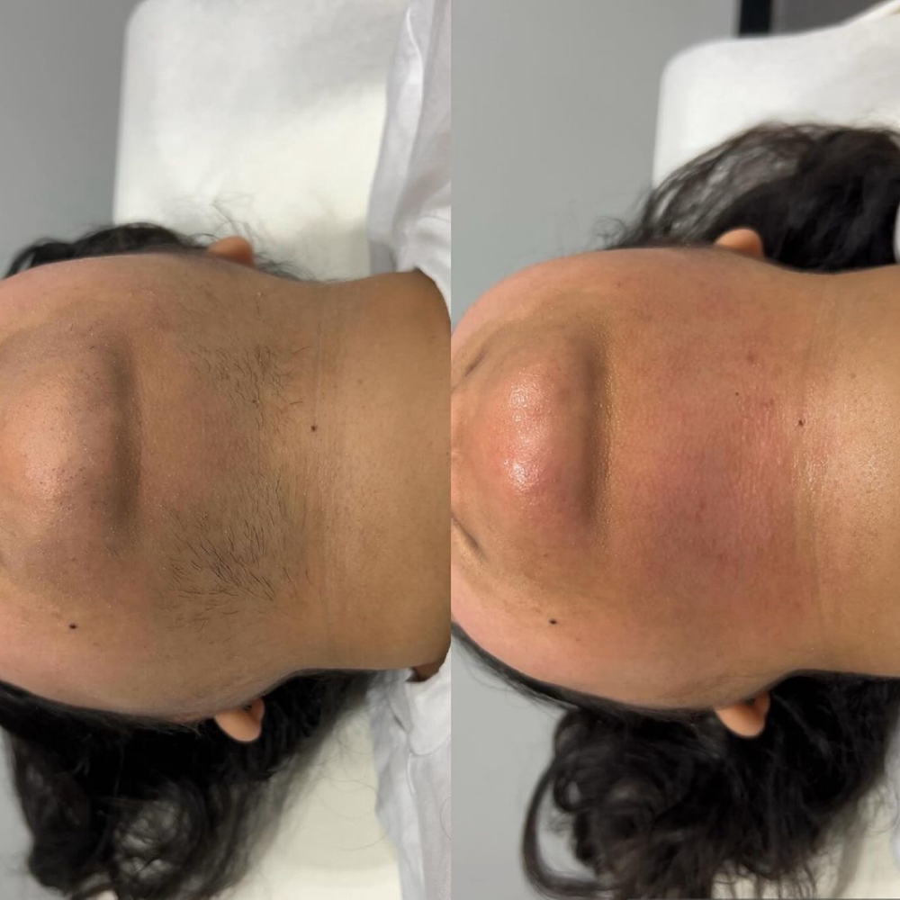 Chin, Cheeks, & Neck Wax at LauLux Esthetics in Bellerose, NY