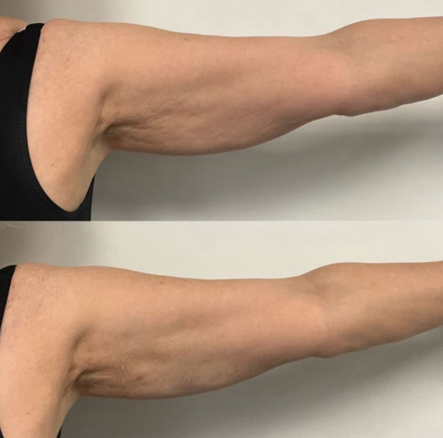 Sculpted Arms Treatment at Blossom Vanity Spa in Missouri City, TX
