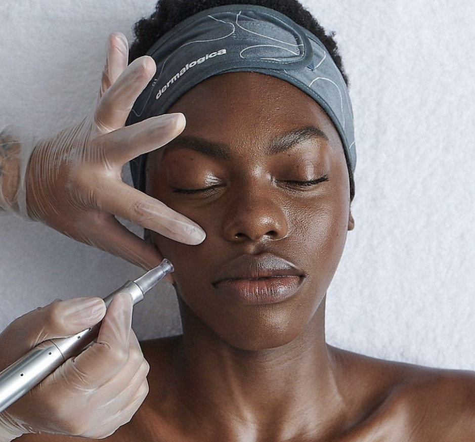 Micro-needling 1 Session
