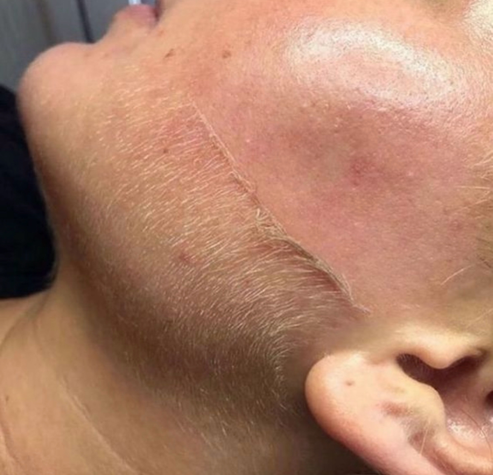 Dermaplaning Facial