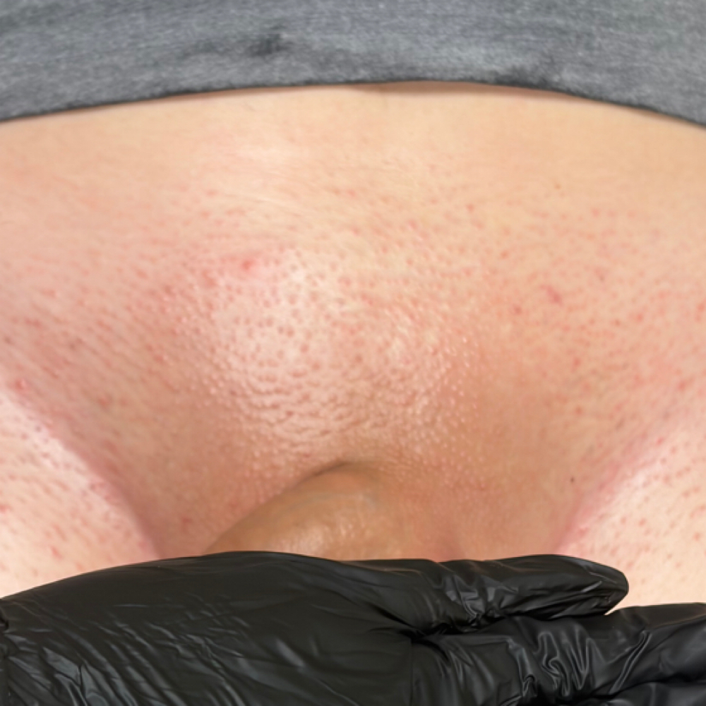 The Brozilian Wax Bundle at Poshii GOAT Esthetics in Carmel, IN