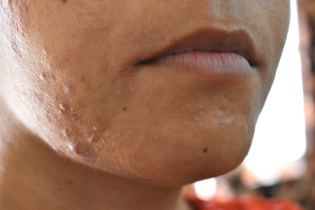 SWICH/Alternative To Chemical Peels