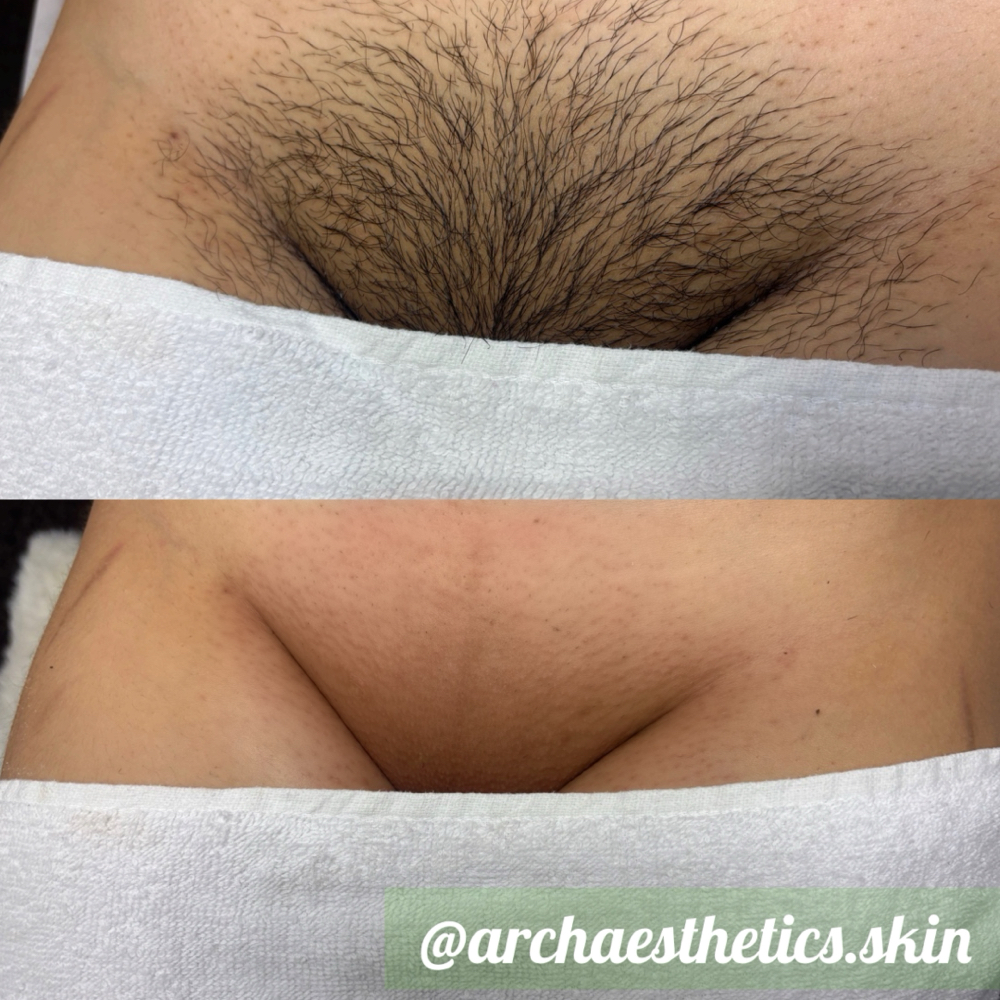Brazilian Wax |FLASH SALE 🔥