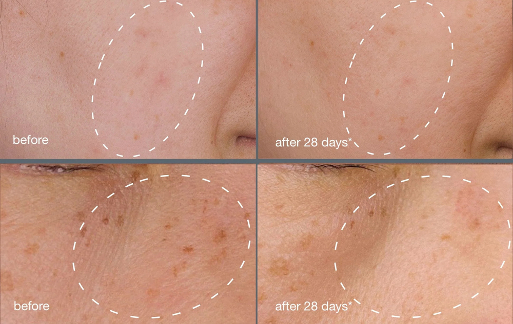 Chemical Peel