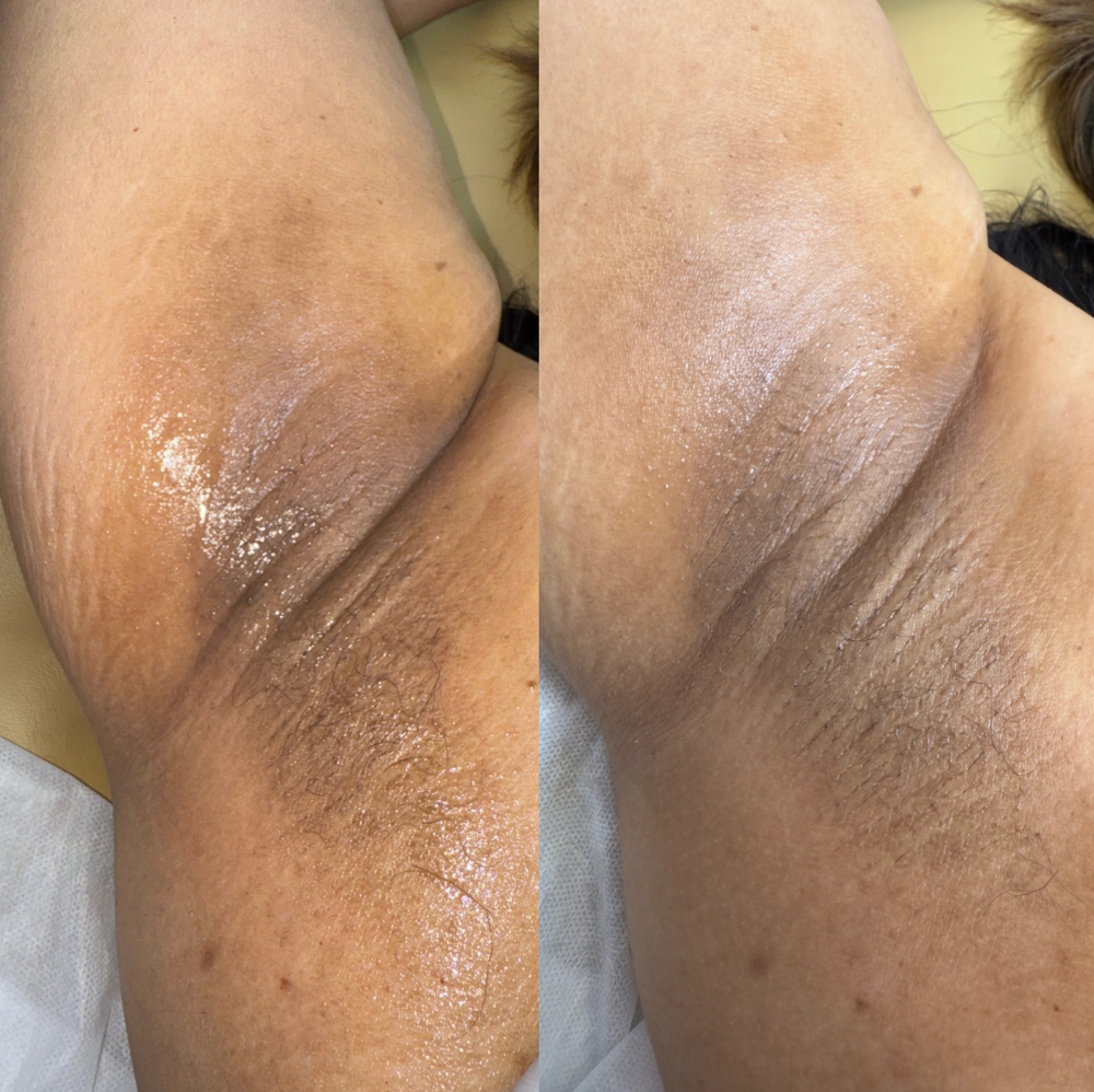 Skin Lightening - Underarms at Classic Waxing Co in La Habra, CA