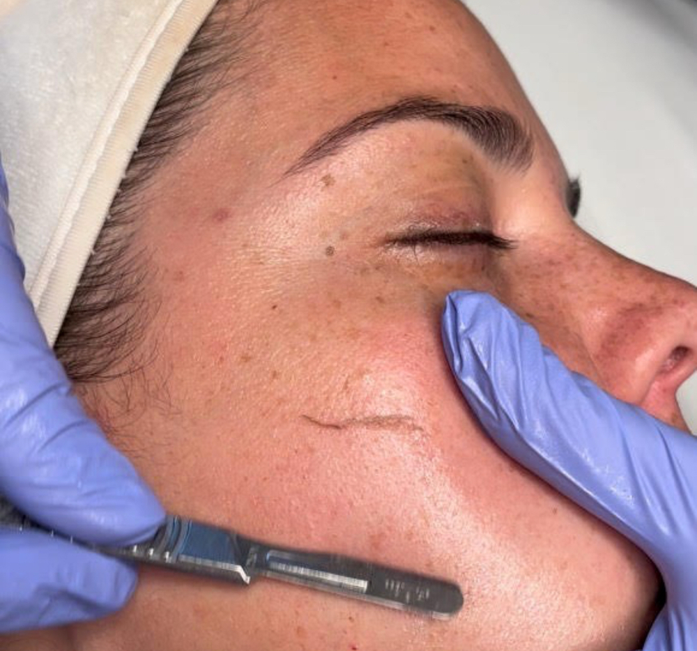 Peach Fuzz Dermaplane at Glow With Beauty LLC in Bristol, CT