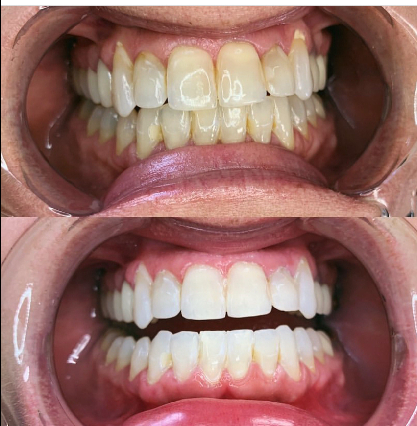 Teeth Whitening