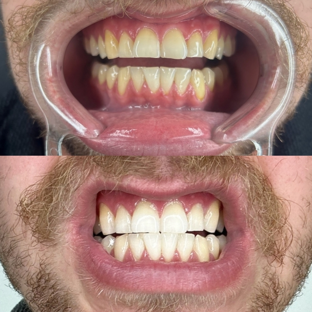 Teeth Whitening 30 Min Session