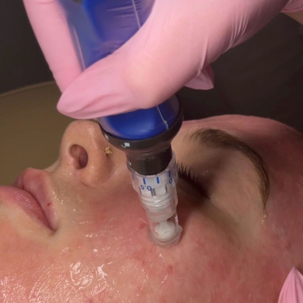 skinpen microneedling face + neck at 828aesthetics in Henderson, NV