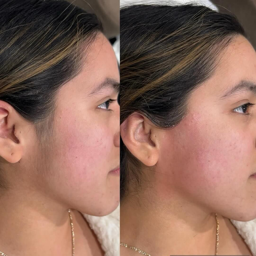 Laser Hair Removal-Sideburns at Radiance Beauty Studio in McAllen, TX