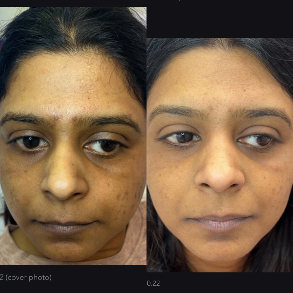 Microneedling With PRP