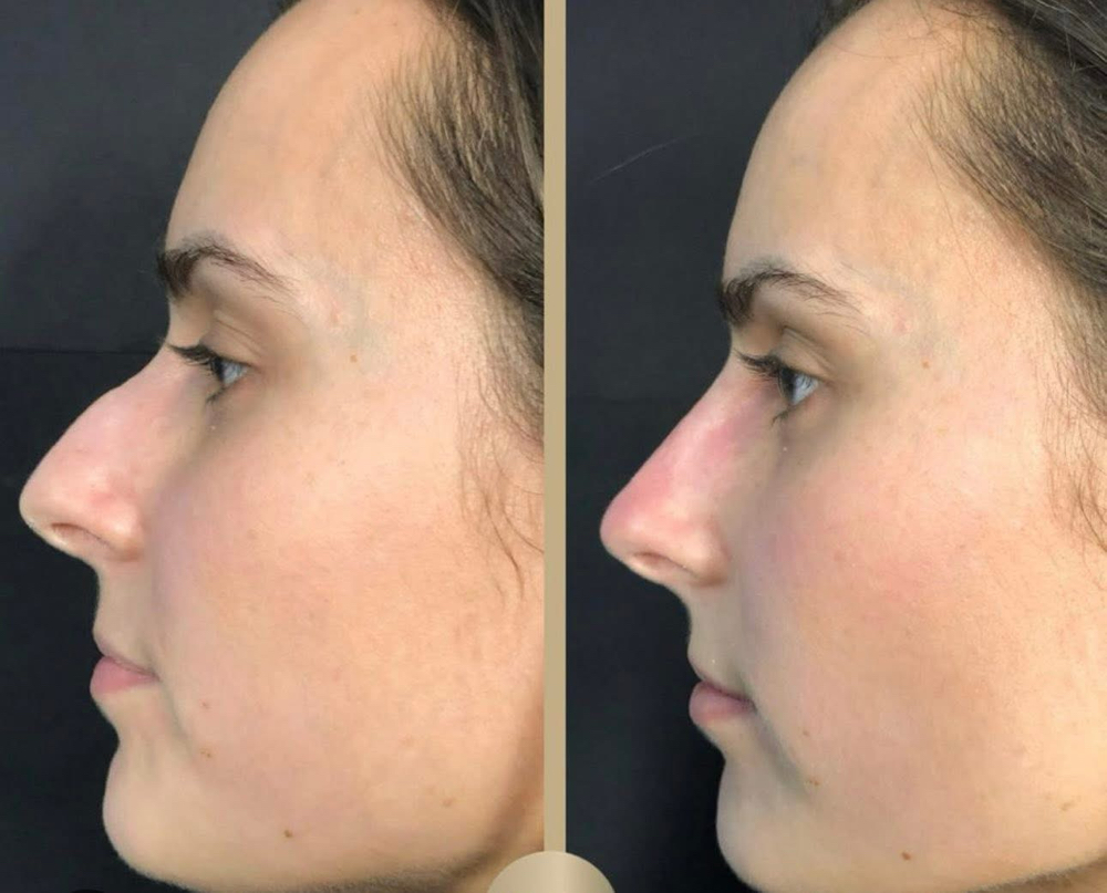 Liquid Nose Job