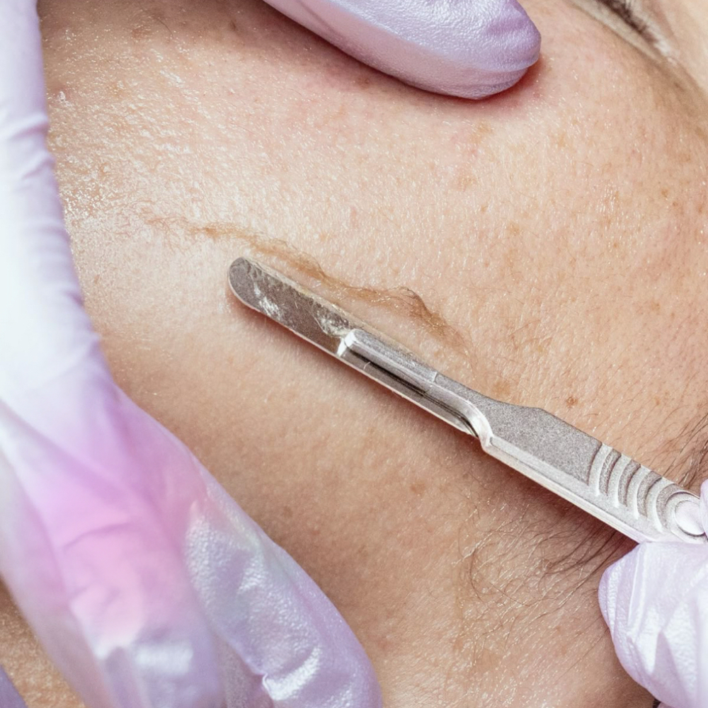 Dermaplane ADD ON at LauLux Esthetics in Bellerose, NY
