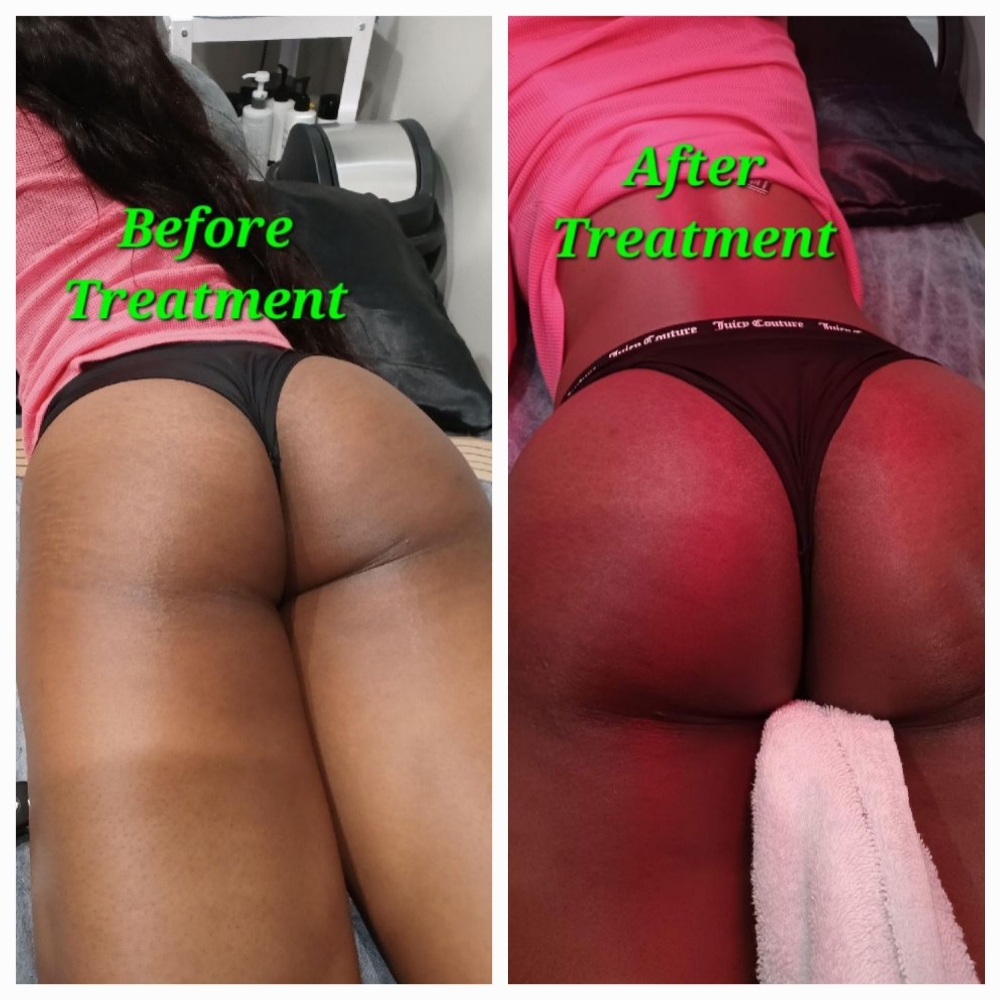 🍑 6 Treatment Butt Lift Package – at JUST BEAUTIFUL SKIN in Goose Creek, SC