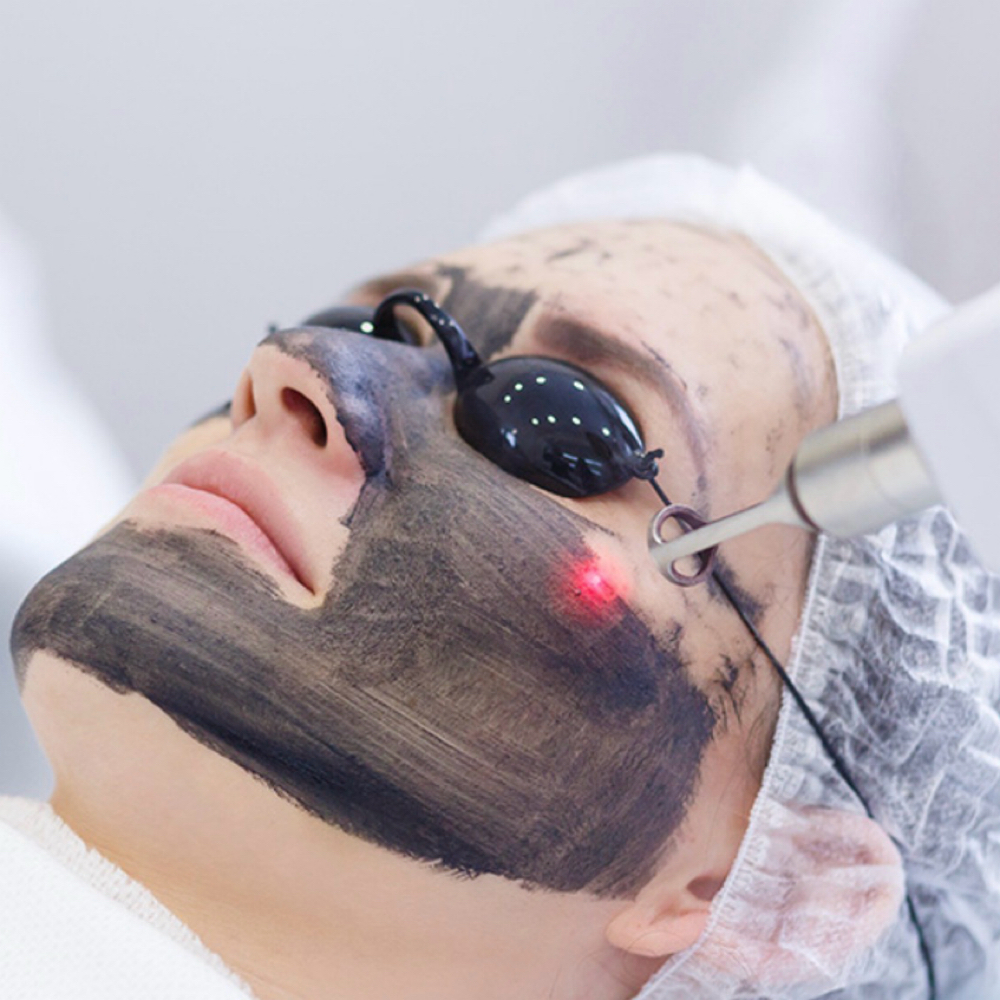 Carbon Laser Peel at Poke Me Pretty Aesthetics in Cleburne, TX