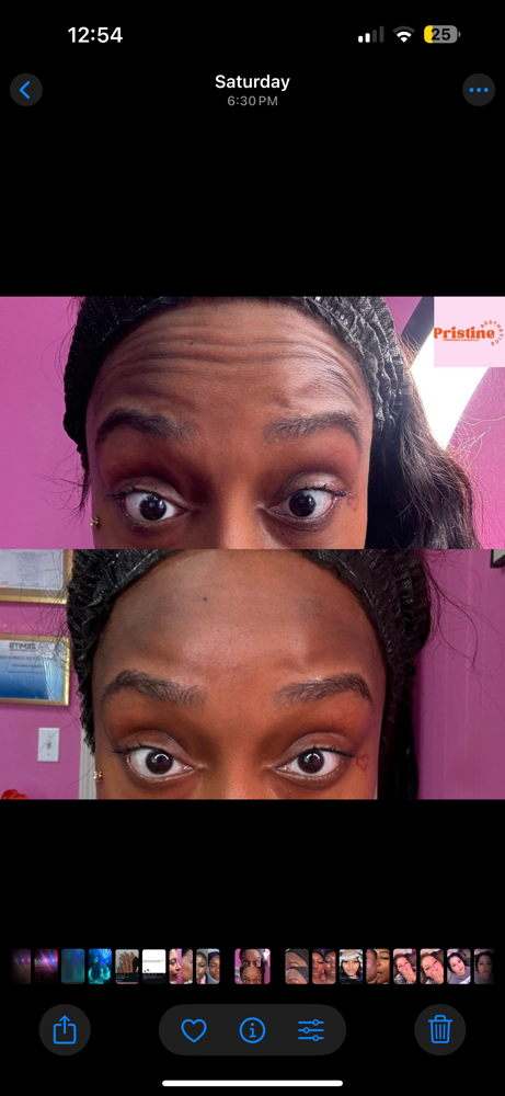 Rf Skin Tightening Single Service